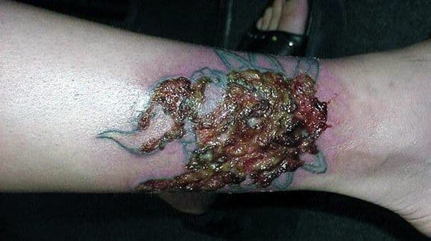 Infección del tatuaje
