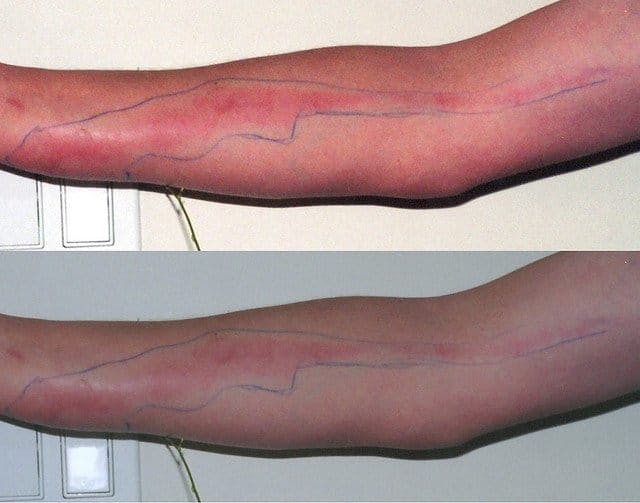Síntomas de la infección del tatuaje