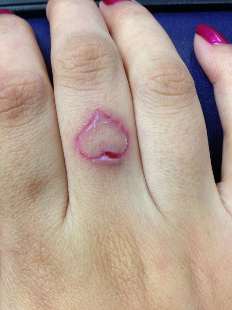 Los tatuajes en los dedos tienen un mayor riesgo de infección 