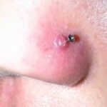 Nose Piercing Infections: Symptoms & Treatment Guide