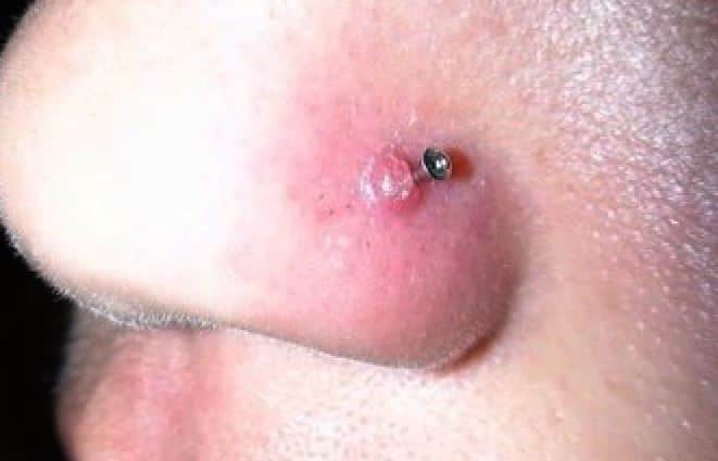 Nose Piercing Infections: Symptoms & Treatment Guide