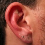 Infección por perforación del oído