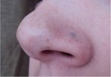 Cicatriz piercing de nariz