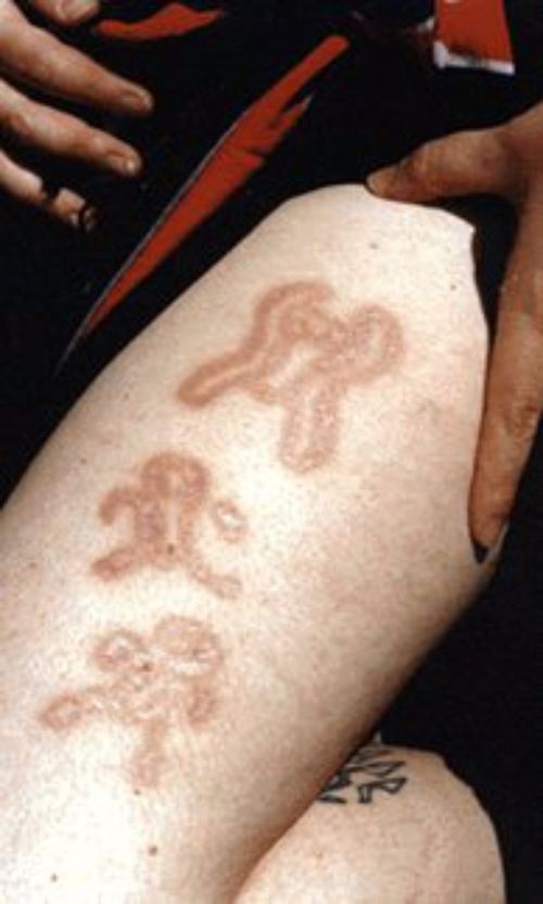 tatuaje de marca de piel